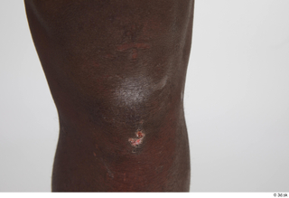 Kato Abimbo knee scar 0001.jpg